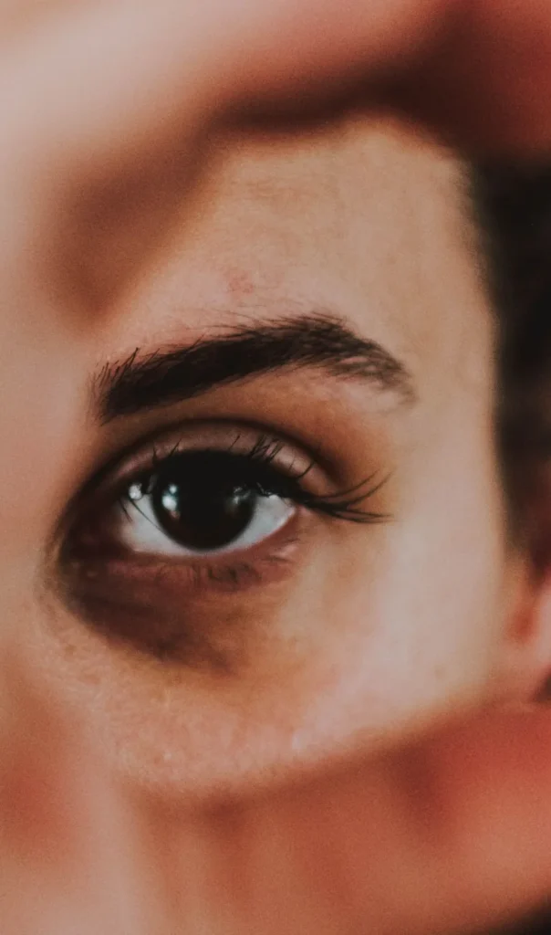 Tratamiento de ojeras