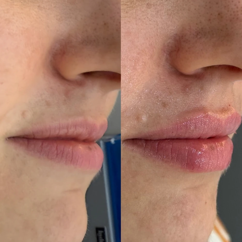 Labios con ácido hialurónico